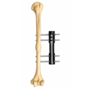 FIXADOR EXTERNO MONOLATERAL PEDIATRICO