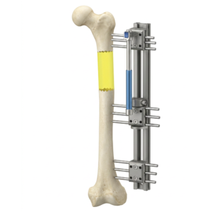 FIXADOR EXTERNO MONOLATERAL TIPO LRS